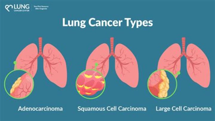 Cassie Davis Dies From Lung Cancer? How Did Cassie Davis Die?
