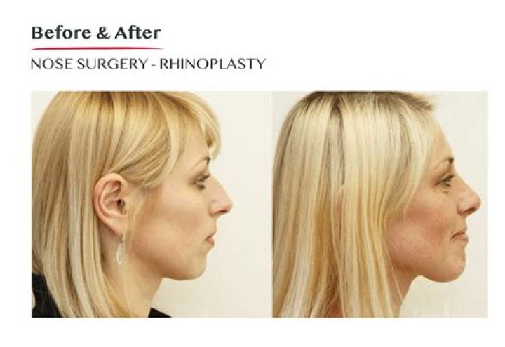 Elsa Pataky Nose Job Plastic Surgery Before and After