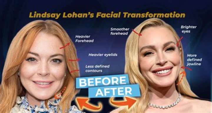 Lindsay Lohan Plastic Surgery: From Rhinoplasty to Fillers and Everything We Know So Far!