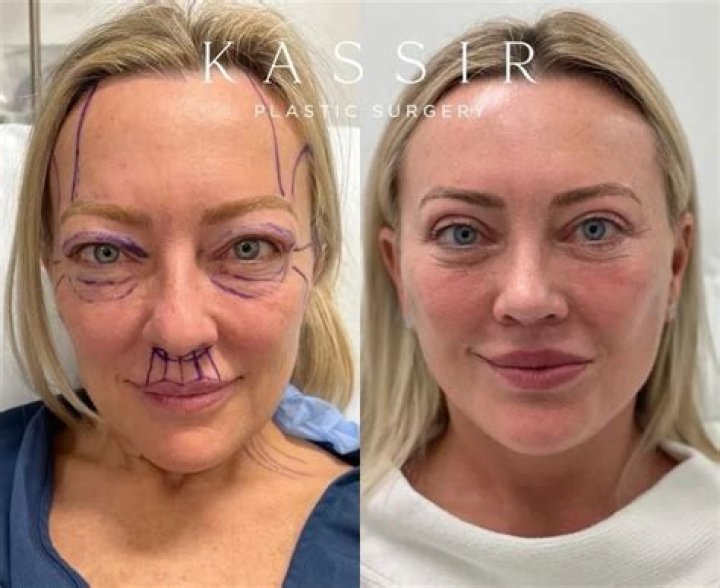 Susan Page Plastic Surgery: Assessing the Probability of Getting Facelift!